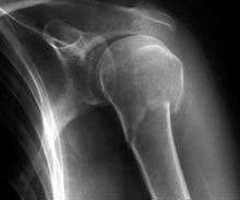 Röntgenbild einer 2-teiligen, soge-nannten subkapitalen Fraktur, die wenig verschoben ist. Diese kann ohne Operation gemacht werden