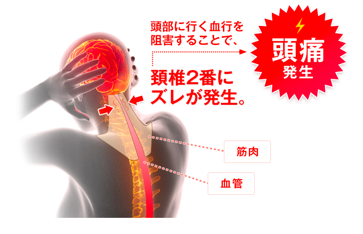 頭痛発生は頚椎２番のずれ