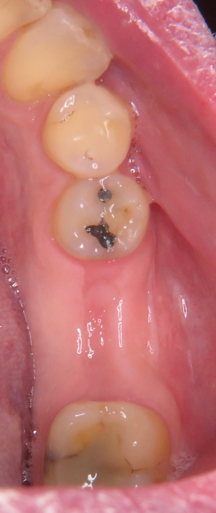 Fehlender Seitenzahn im Unterkiefer ersetzt durch ein Keramikimplantat der Implantatexperte
