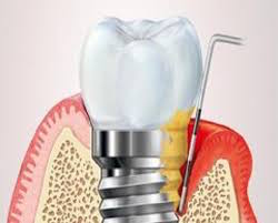 Sondierung eines Implantats mit einer Periimplantitis-Erkrankung