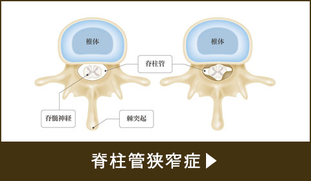 脊柱管狭窄症