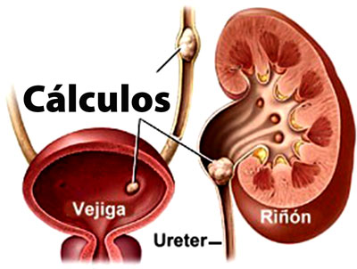 Resultado de imagen para calculos renales