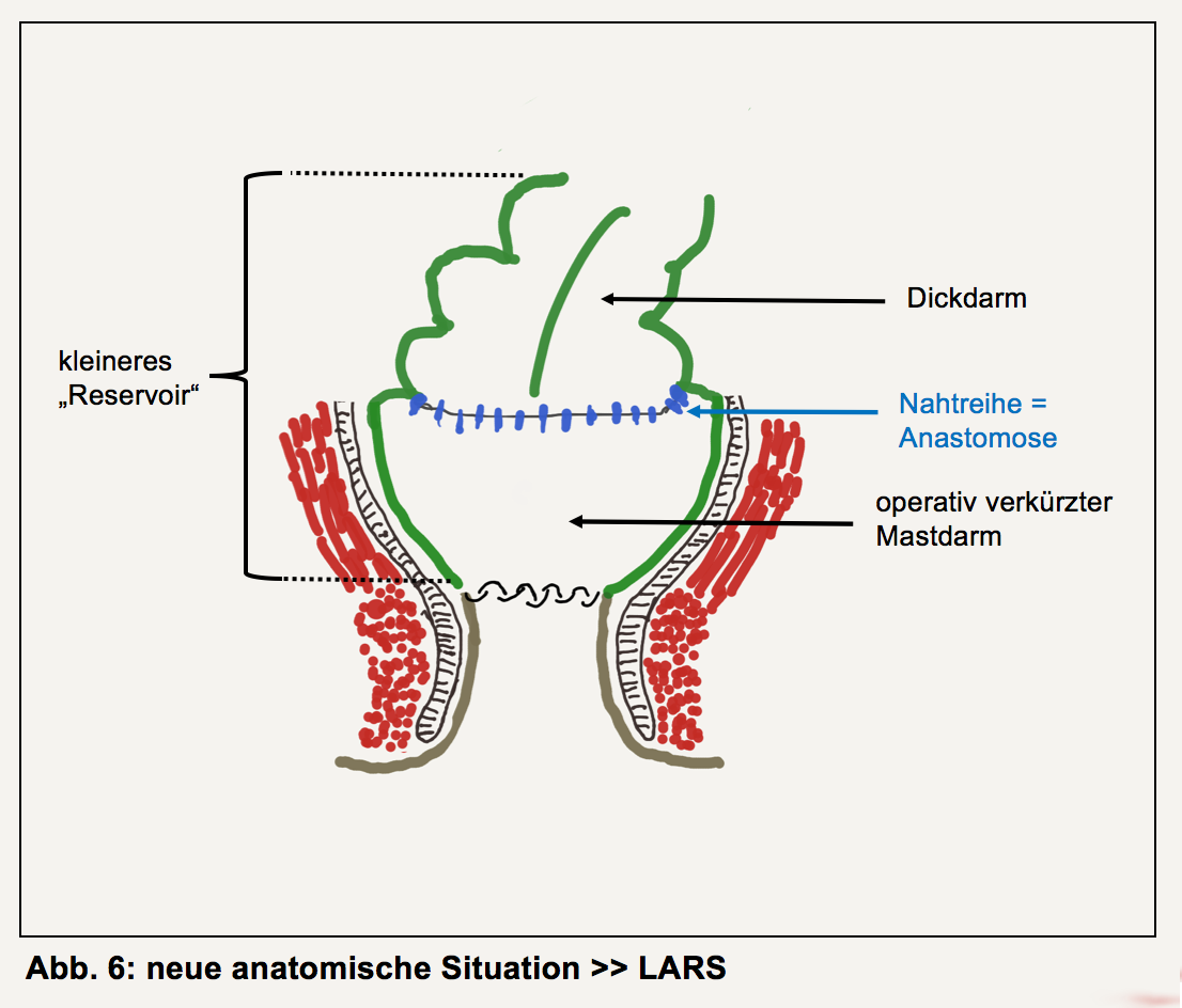 Experteninterview Stoma Rückoperation Teil 2 Kontinenzblog Pelvipedia