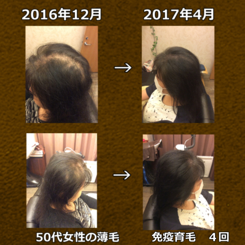 50代女性　多発性脱毛と乾燥による脱毛症の混合