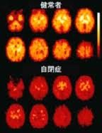 健常者と自閉症の人の脳の断面写真。「セロトニン」の密度が低下していると、暗く見える Image:毎日jp 2010.1.5