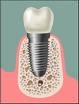 implant dentaire