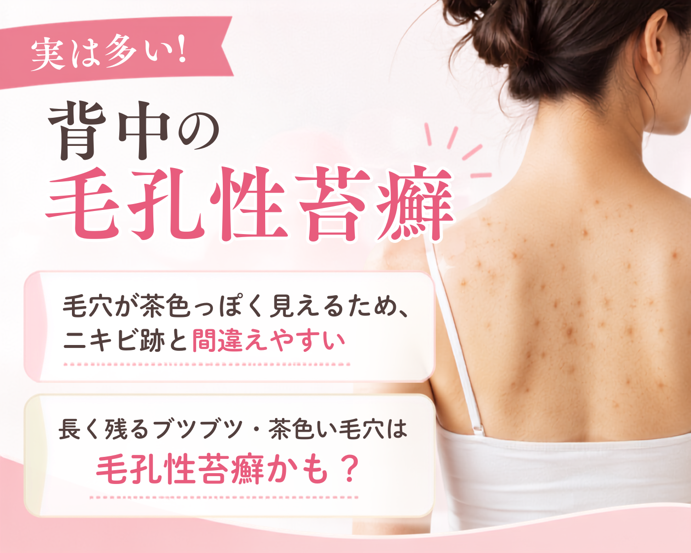 背中のニキビ跡だと思っていたら、毛孔性苔癬かも？