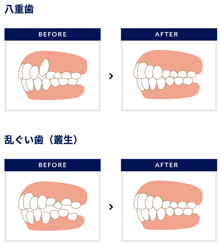 乱ぐい歯
