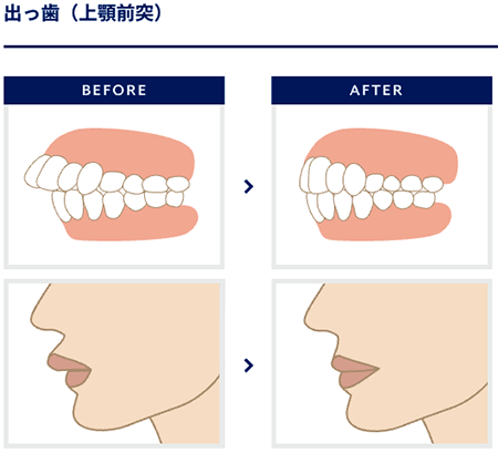 出っ歯