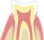 歯周病初期状態のイラスト図