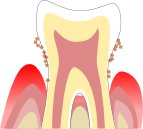 歯周病中程度のイラスト図