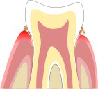 歯周炎のイラスト図