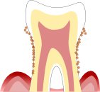 歯周病重症のイラスト図