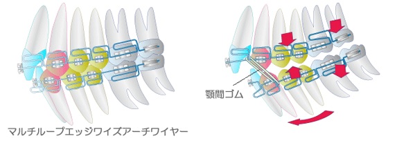 矯正装置のイラスト図：マルチループエッジワイズアーチワイヤーや顎間ゴムを装着した図