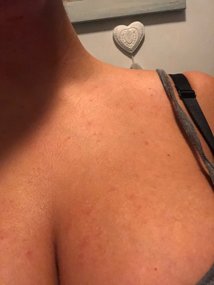 The chest rash I got 😩