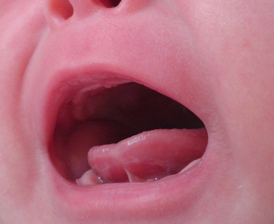 赤ちゃん 舌 白い
