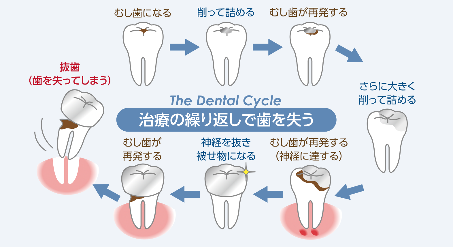 即日で銀歯を白い歯に！？ 〜ダイレクトボンディング〜