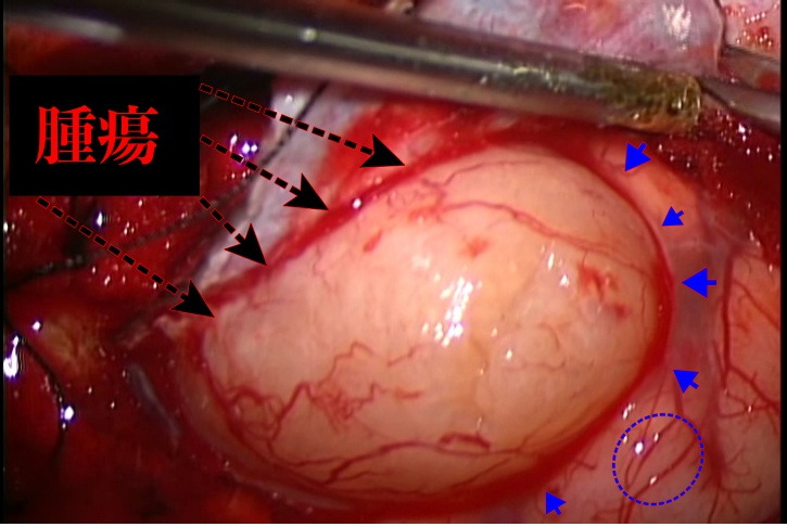 腫瘍血管が発達していない髄膜腫を說明した手術中の画像