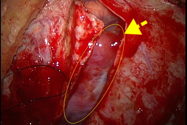 手術にて硬膜を切開した後に髄膜腫が露出している画像