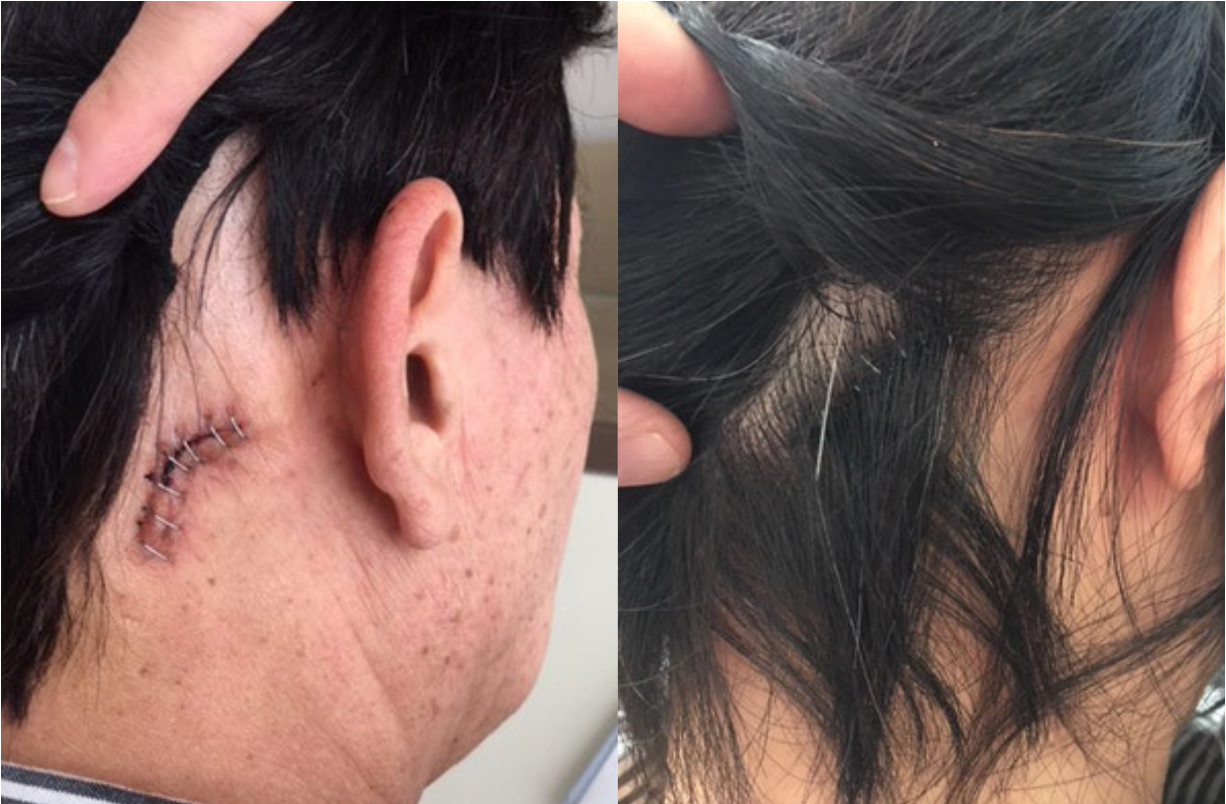 熟女痙攣 gif 顔面痙攣 手術 (1) - 脳外科医 根本暁央