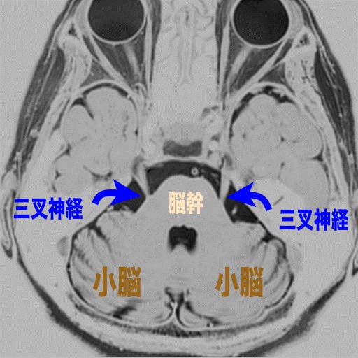 頭部MRI検査での三叉神経の走行を小脳