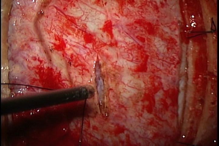 髄膜腫の手術中の所見。硬膜をわかりやすく示した画像