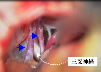 三叉神経痛の手術；三叉神経周囲の大切な構造物（血管）をわかりやすくした手術時の画像