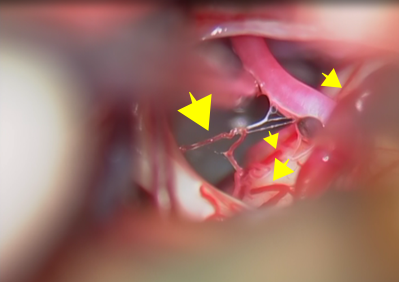 三叉神経痛の手術；三叉神経周囲の大切な構造物（血管）をわかりやすくした手術時の画像２