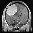 ドックにて発見された巨大髄膜腫の４１歳女性の症例　術前画像MRI−２