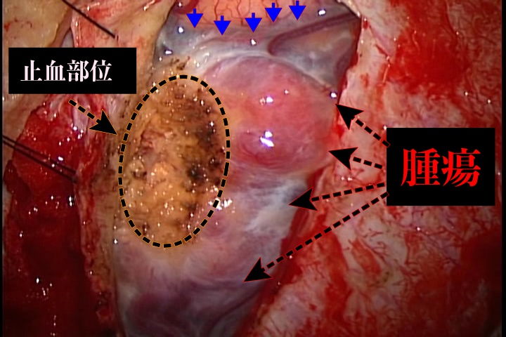 髄膜腫を一部を摘出した時の画像