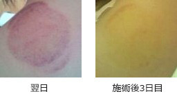 吸い玉、消えるまでの色の変化(翌日~施術3日後)