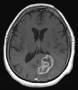 Hirntumore/Gliome - megele-rs Webseite!