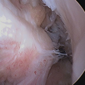 Intraoperative Sicht eines vorderen Kreuzbandrisses