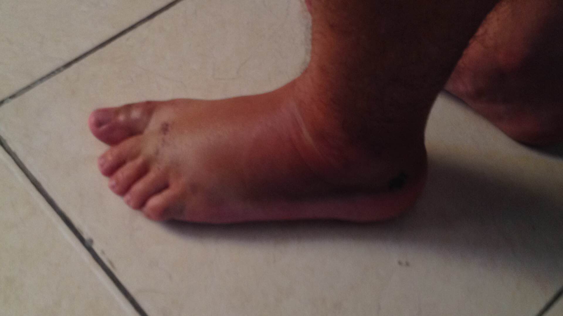 Il mio piede gonfio dopo l'incidente in moto