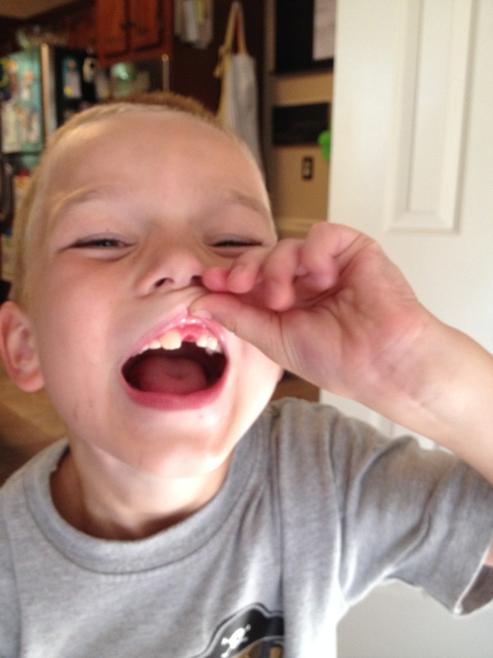 A. hat in der Schule einen Zahn verloren - beim Brokkoli essen!