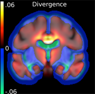 Divergence du flux de déformation dans l’évolution de la maladie d’Alzheimer: la couleur représente les régions changeant de volume