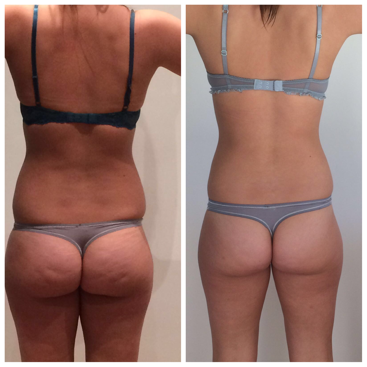 nach 4 Wochen keine Cellulite mehr