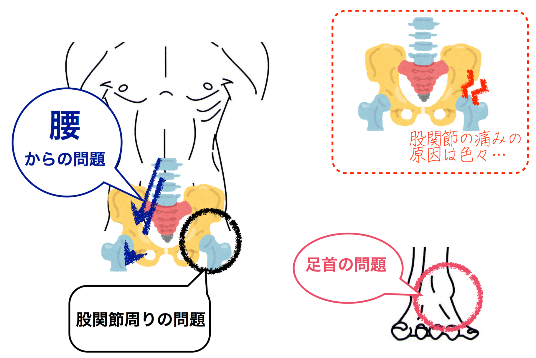 痛 トレ 股関節 筋