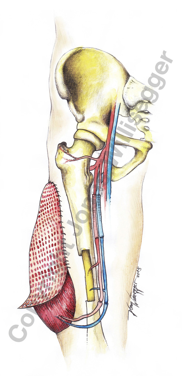 Illustration für Unfallchirurgie (Aquarell)