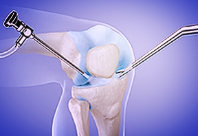 Arthroskopie des Kniegelenks