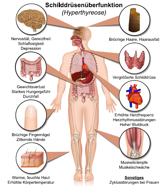 Bildbeschreibung zu Symptome bei einer Schilddrüsenüberfunktion bzw. Hyperthyreose.