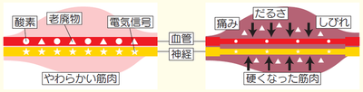 シビレや痛みの原因