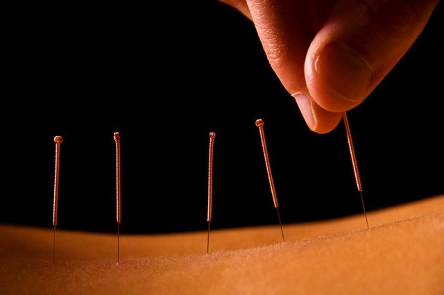 Acupuncture merveilleuse, 2000 ans de soins holistiques et naturels