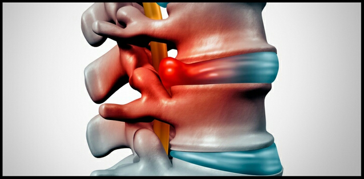 ¿Cómo se produce una hernia discal o rotura de disco en la columna?