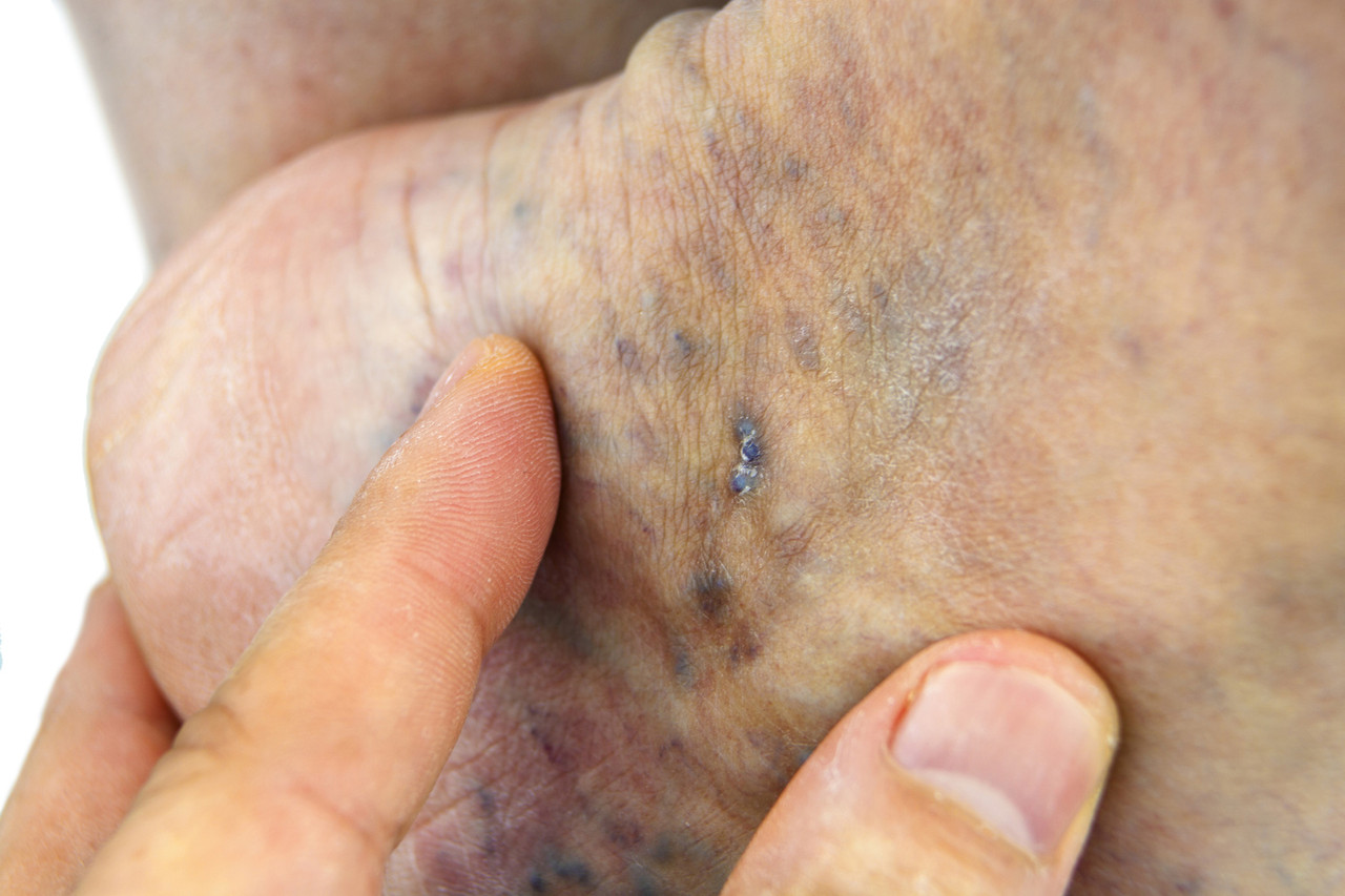 Varicoză pigment spots, Spot pe picior cu vene varicoase