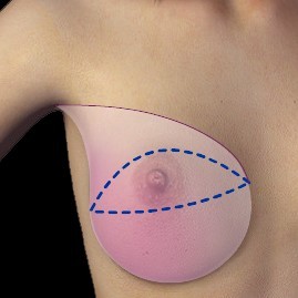 mastectomie : en rose ce qu'on enlève (sous la peau) Et en pointillés bleus les incisions : tout le téton est donc ôté
