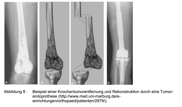 Zum Osteosarkom Eine vergleichende Literaturstudie Osteosarkom Hund