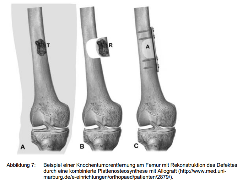 Zum Osteosarkom - Eine vergleichende Literaturstudie - Osteosarkom Hund / Osteosarcoma Dog ...