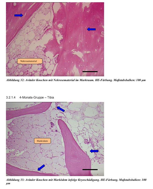 Etablierung eines kryochirurgischen Behandlungsverfahrens ...