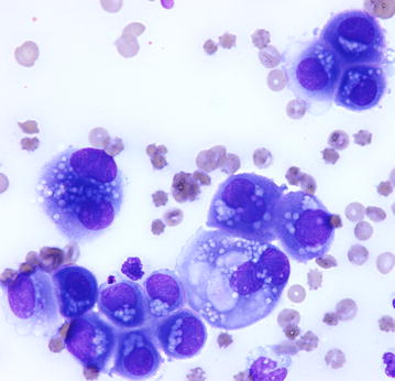 mesothelioma cytology pathology